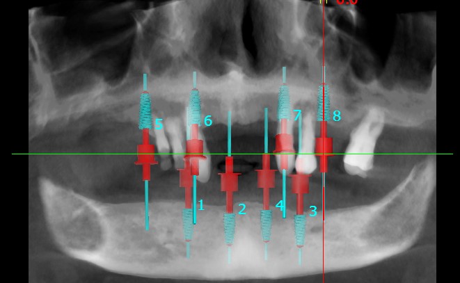 Implant dentar