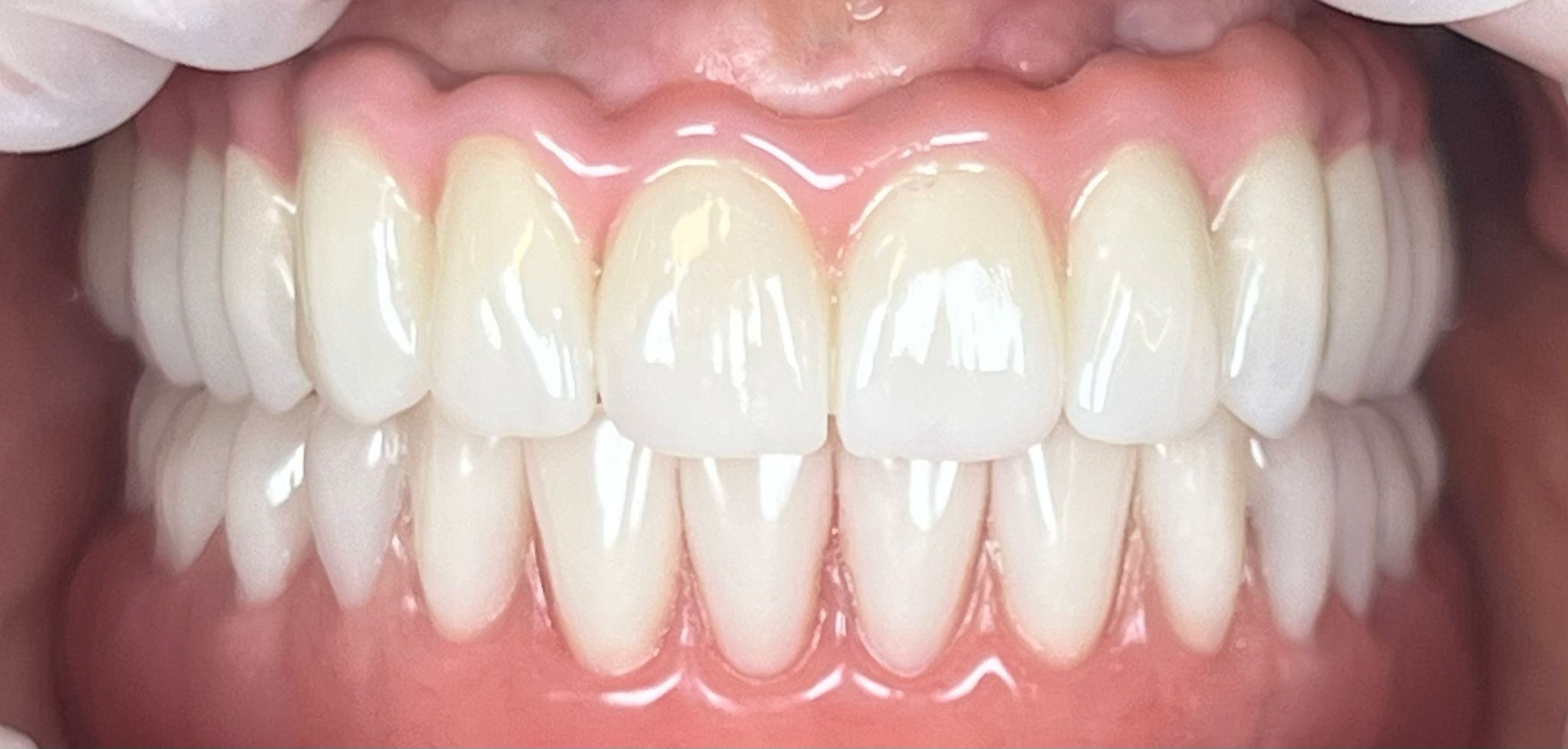COROANĂ ZIRCONIU INTEGRAL PE IMPLANT