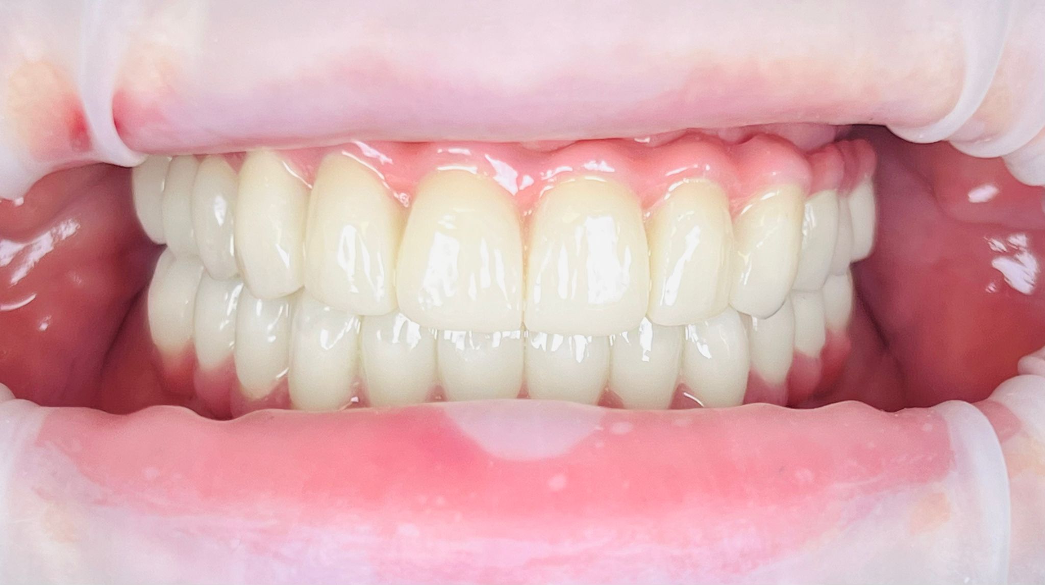 Coroană zirconiu integral pe implant