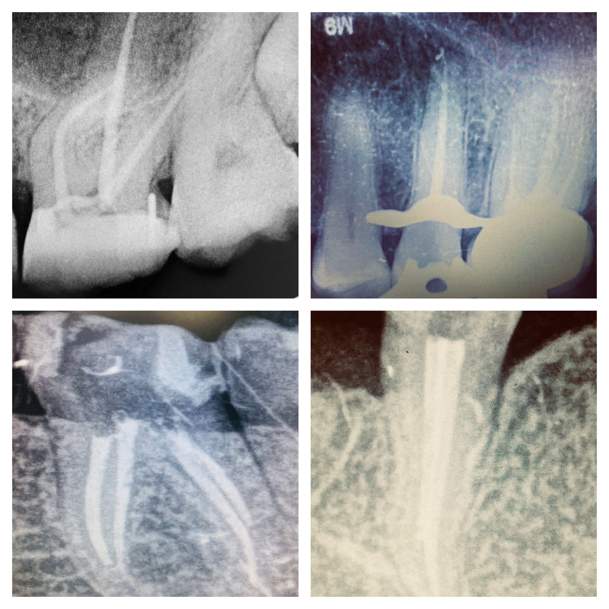 endodontie