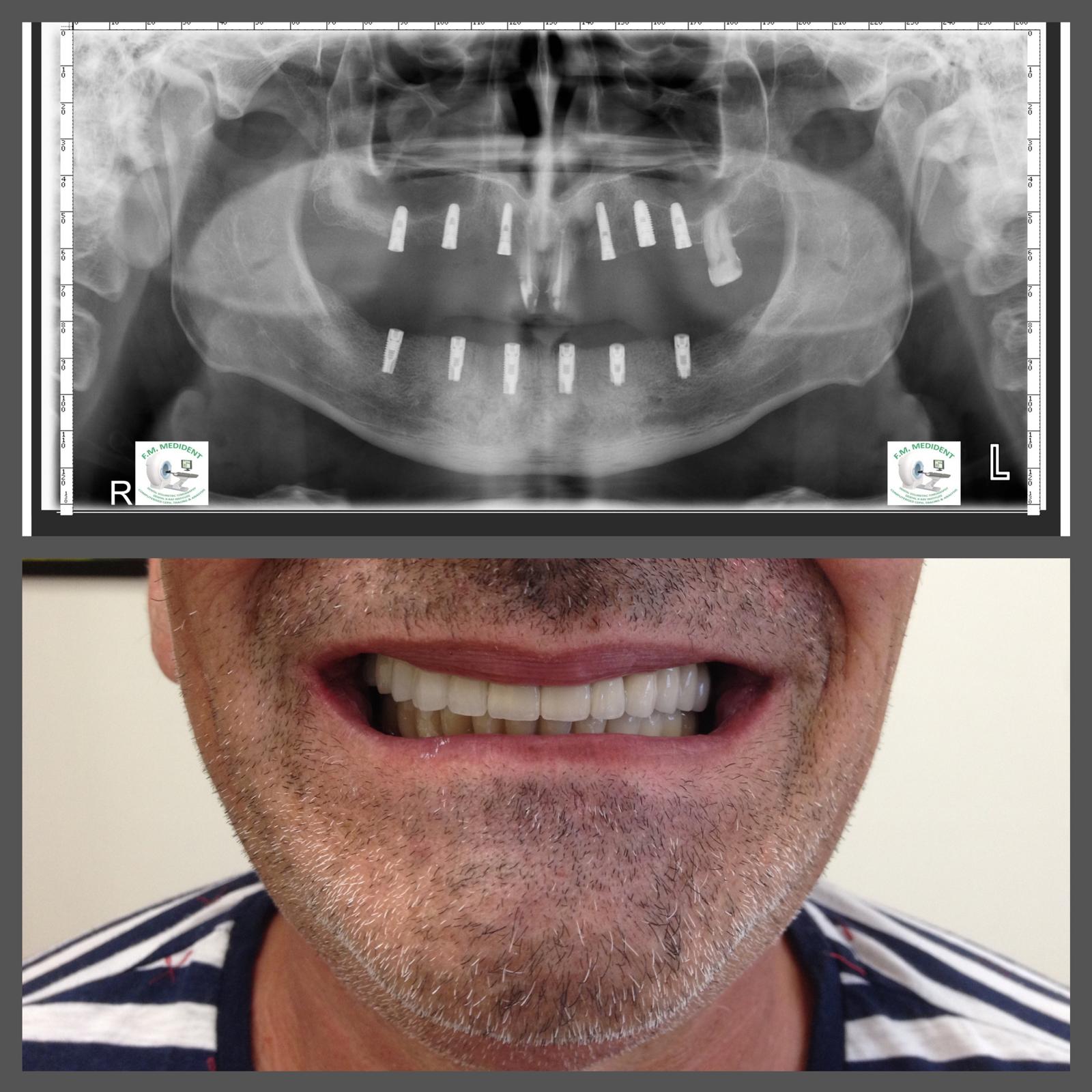 Sinus-lift extern
