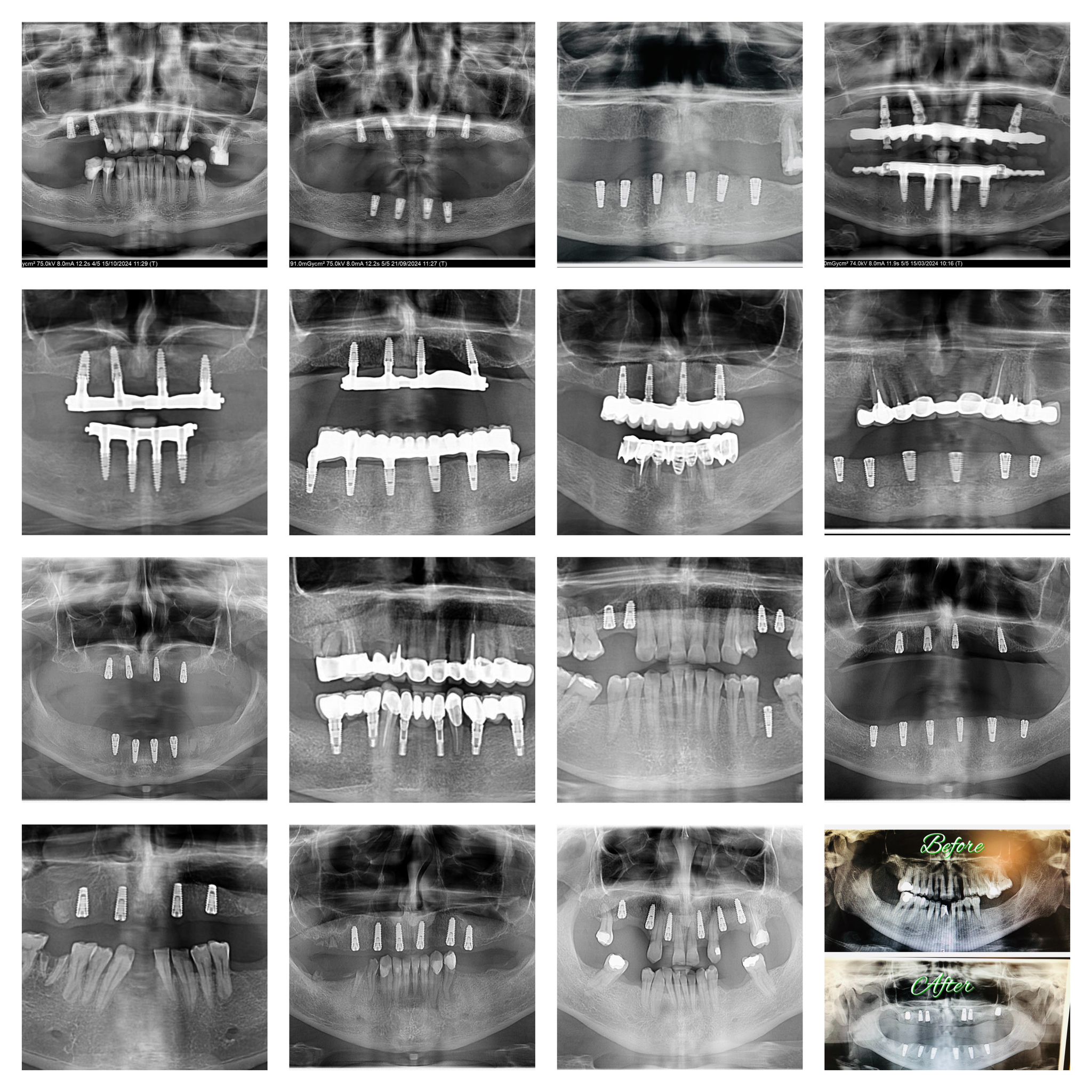 Implant dentar Inno