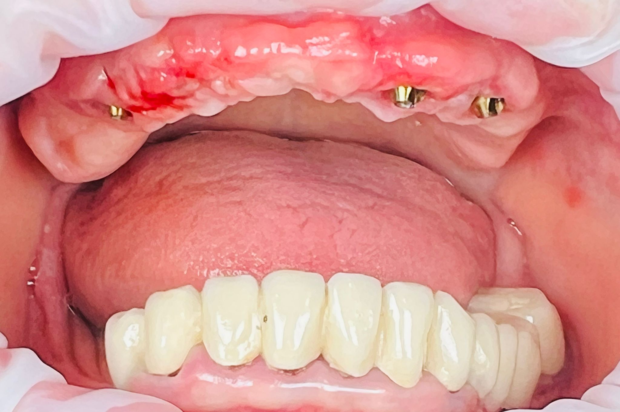 implanturi_dentare