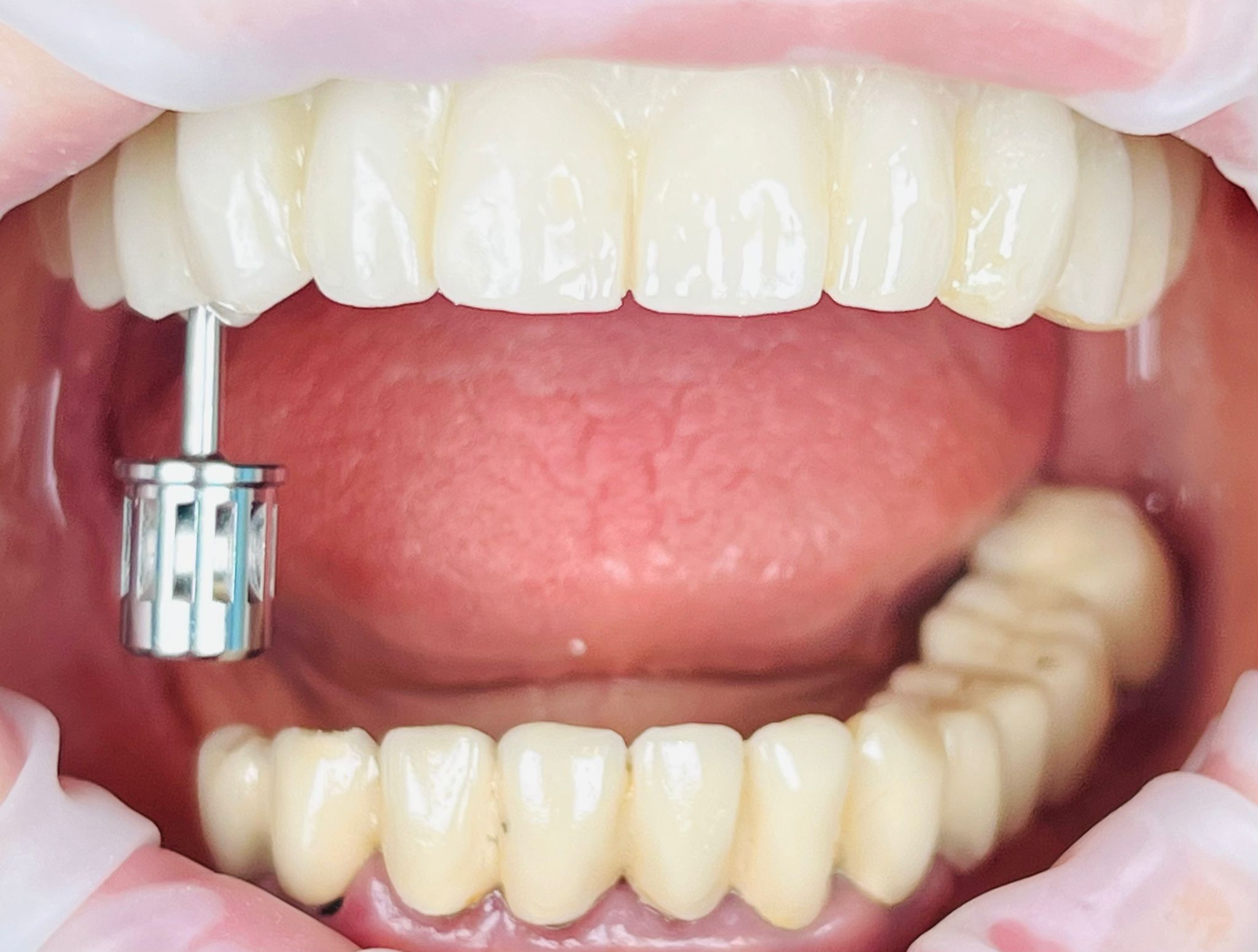 sinus_lift_intern_implant_dentar