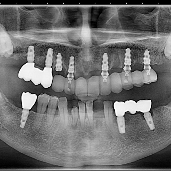 Radiografie after